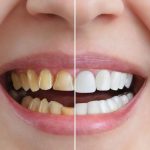 Benefits of Cosmetic Dentistry Beyond Aesthetics